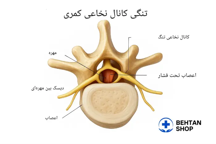 تنگی کانال نخاعی کمری