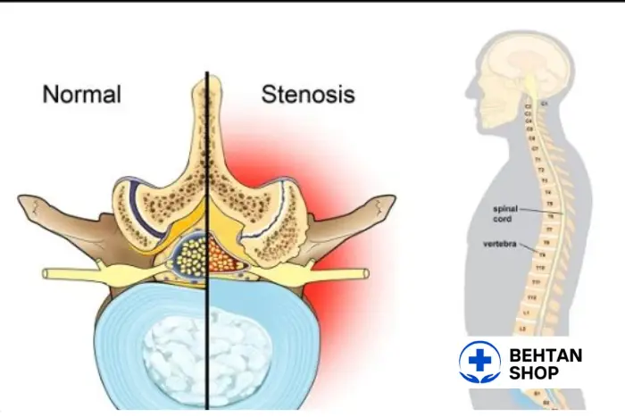 علائم تنگی کانال نخاعی