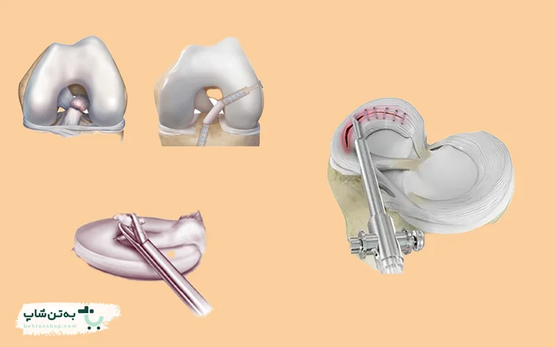 کاربرد آرتروسکوپی زانو | بهتن شاپ