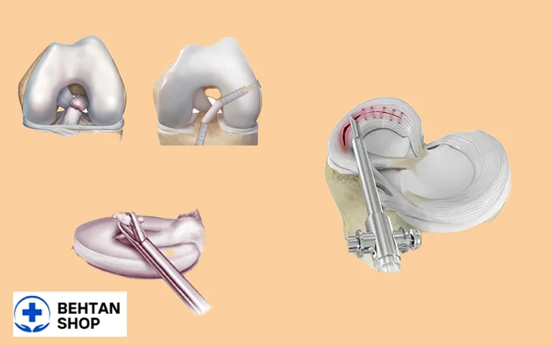 کاربرد آرتروسکوپی زانو | بهتن شاپ