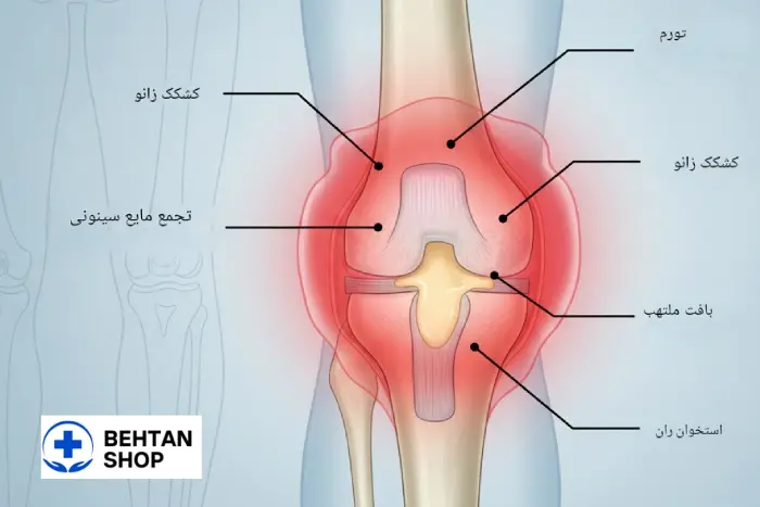 آب آوردن زانو