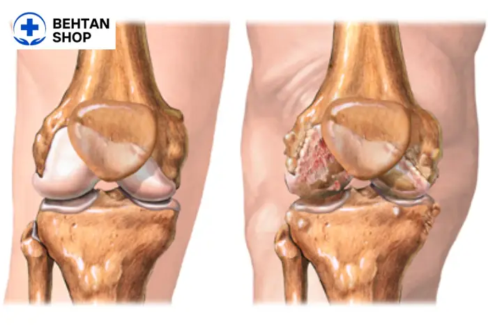آرتروز زانو چیست