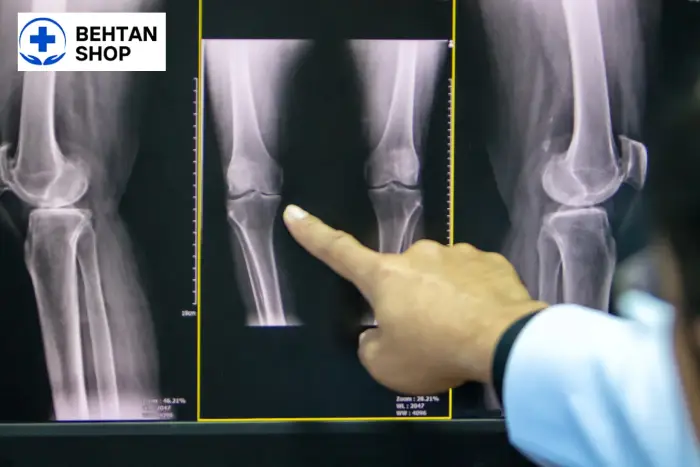 تشخیص آرتروز زانو