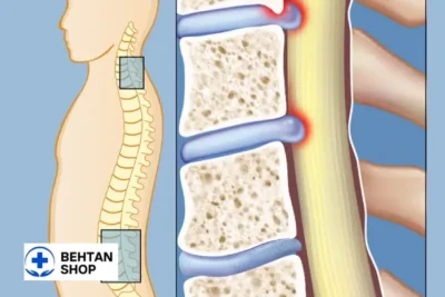 تنگی کانال نخاعی