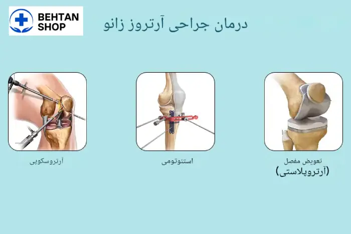 درمان آرتروز زانو با جراحی