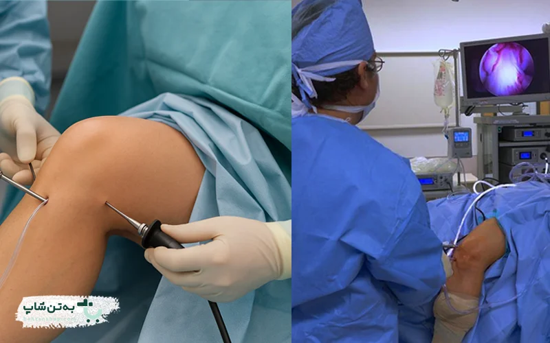 آرتروسکوپی زانو | بهتن شاپ