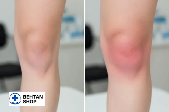 علائم آب آوردن زانو