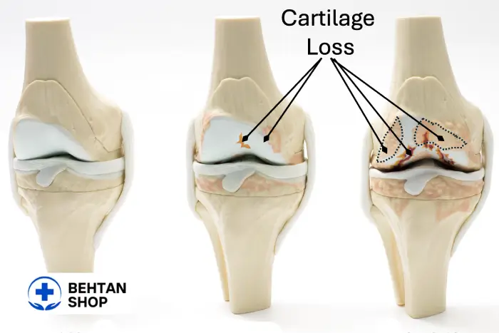 پیشرفت آرتروز زانو