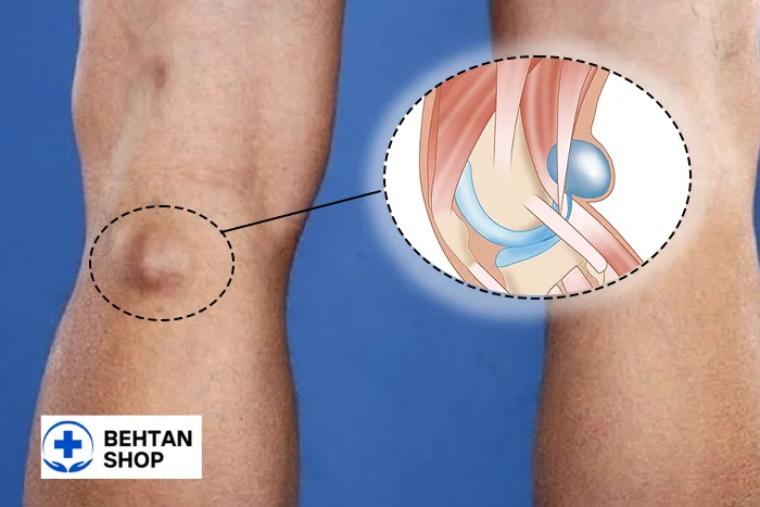 کیست بیکر در پشت زانو | بهتن شاپ