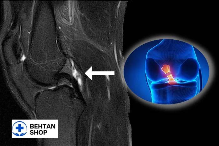 کیست رباط صلیبی زانو | بهتن شاپ
