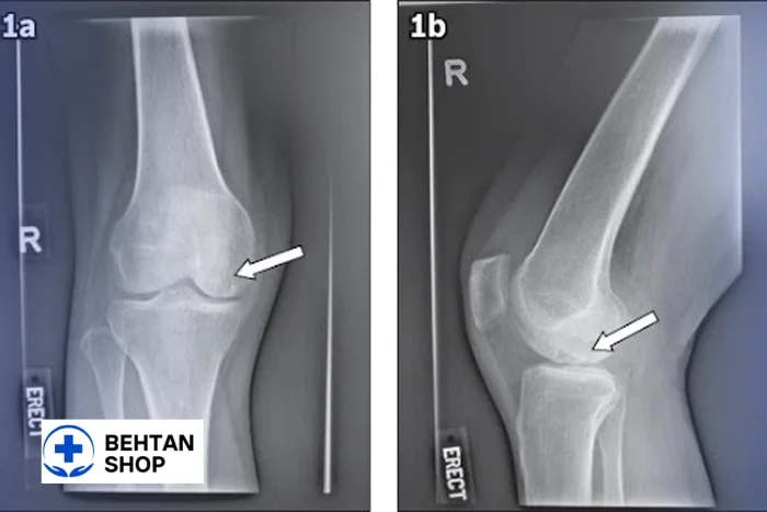 کیست استخوانی زانو | بهتن شاپ
