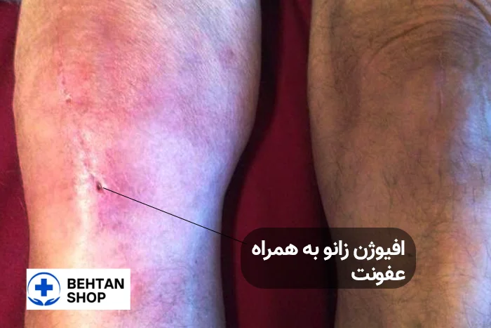 افیوژن زانو در اثر عفونت مفصل | بهتن شاپ
