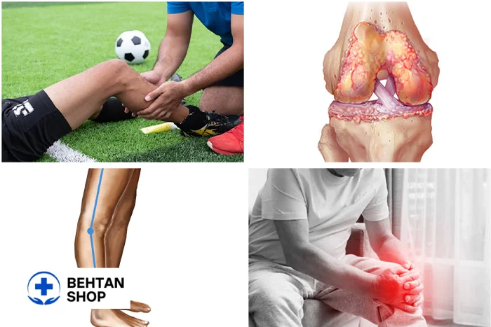 علت ایجاد کیست زانو | بهتن شاپ