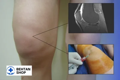 افیوژن زانو | بهتن شاپ