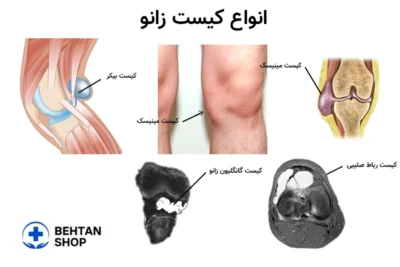 انواع کیست زانو | بهتن شاپ