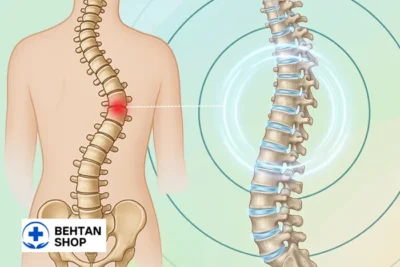 انحراف ستون فقرات | بهتن شاپ
