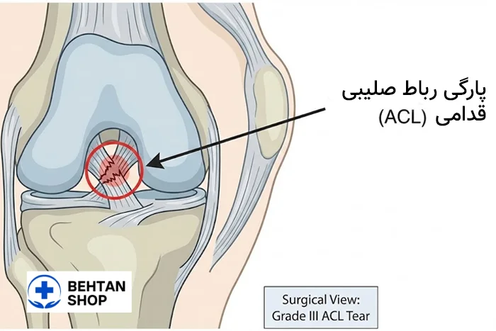 پارگی رباط صلیبی | بهتن شاپ