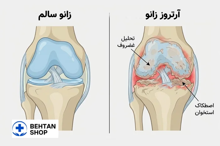 آرتروز زانو | بهتن شاپ